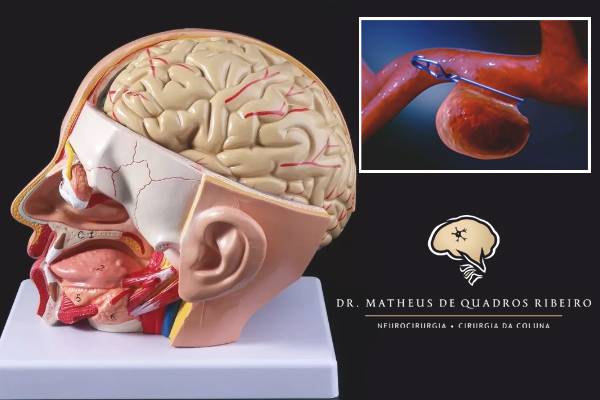 Clipagem de aneurisma cerebral