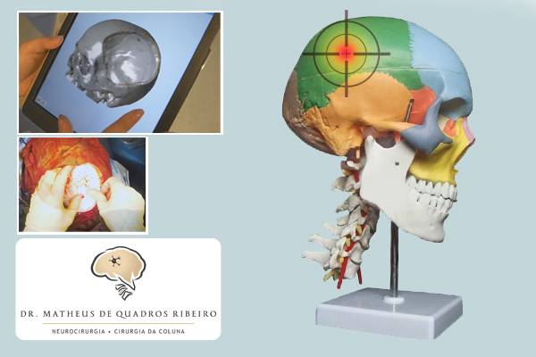 Cranioplastia
